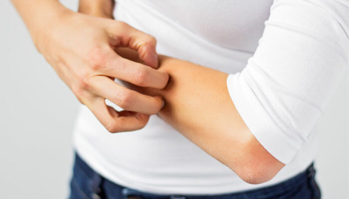 Habits to Adopt and Avoid to Manage Eczema